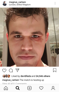 Photo by Magnus Carlsen, showing his black eye, from a clash of heads while playing football on the rest day.